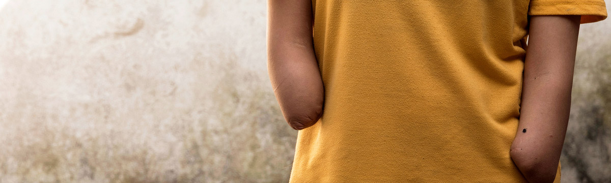 Sabita fra Nepal mistet begge hendene. Inkludering av barn med funksjonsnedsettelser.