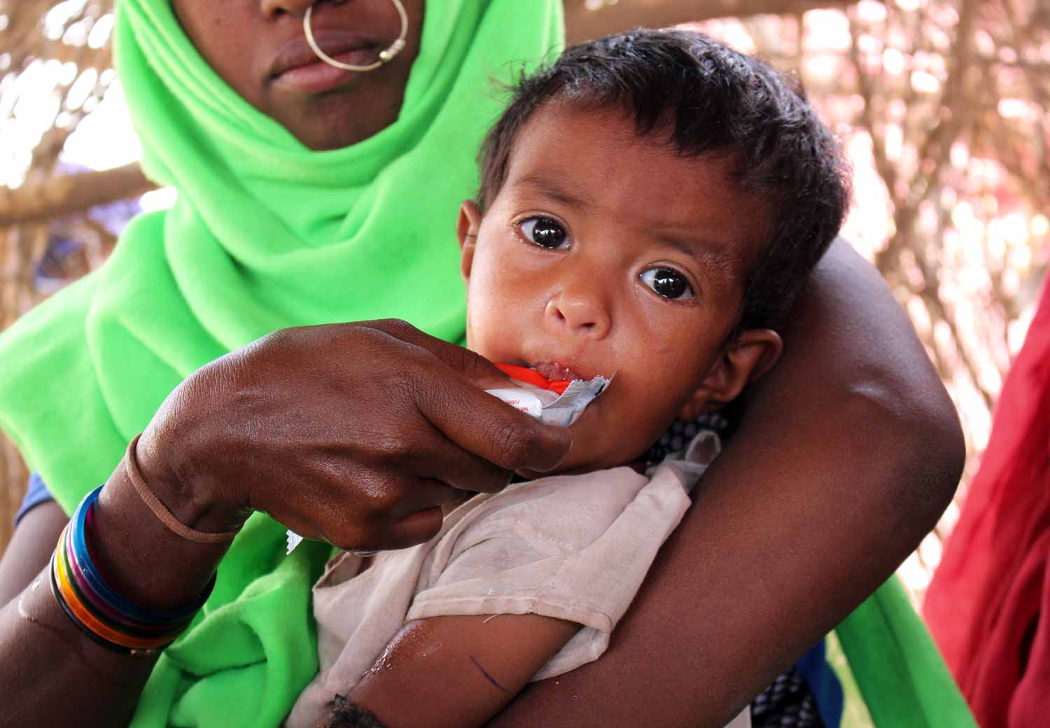 Ibrahim på syv måneder fra Sudan lider av alvorlig underernæring.