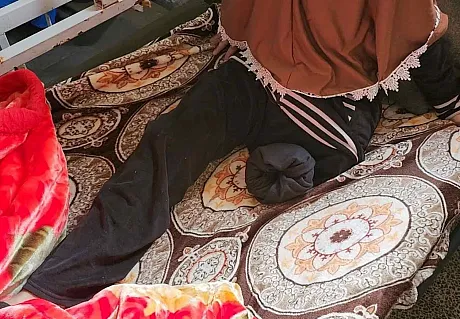Amal måtte amputere beinet etter et luftangrep fra Israel.